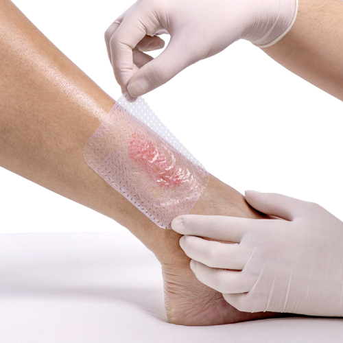 Manejo de heridas y estomas