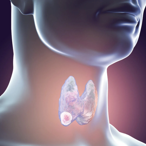 Enfermedades benignas y malignas de cabeza y cuello