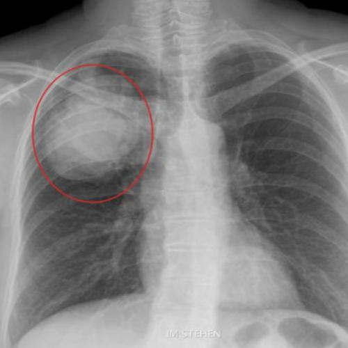 Tumor metastásico de origen indeterminado
