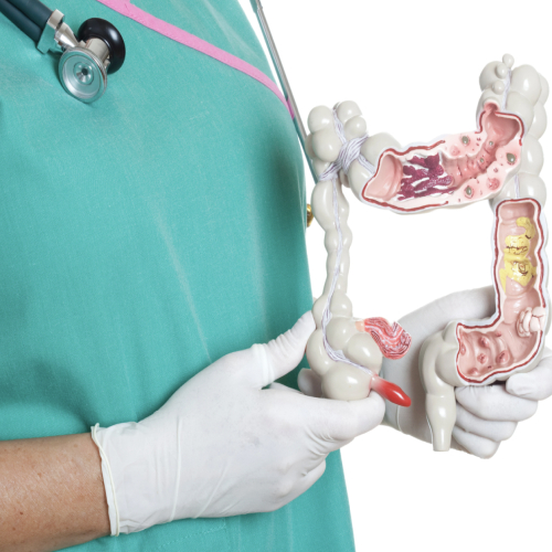 Tumores de Colon y Recto