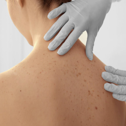 Evaluación de tumores de piel y tejidos blandos